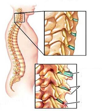 osteochondrosis a gerinc 2 része)